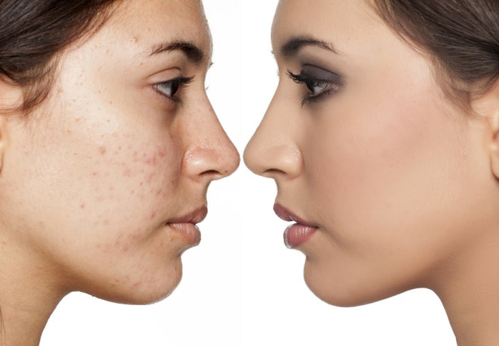Distinguishing Between Dark Spots and Acne Scars: Identifying Variances and Appropriate Treatment Methods