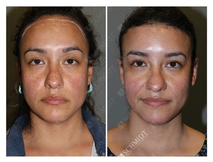 Enhancing Facial Harmony: Exploring Forehead Reduction Surgery